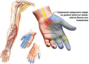 Причины онемения среднего, указательного, большого, мизинца и безымянного пальца правой и левой руки. Как и чем лечить онемение пальцев и кисти правой и левой руки?