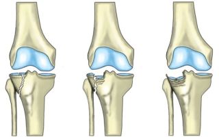 Импрессионный перелом мыщелка бедренной кости: латерального