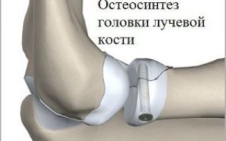 Перелом головки лучевой кости локтя: лечение и восстановление