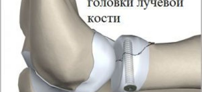 Перелом головки лучевой кости локтя: лечение и восстановление