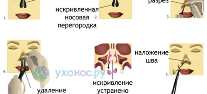 Перелом носа: степень тяжести вреда здоровью, открытый, закрытый