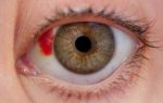 Травма глаза: первая помощь и лечение в домашних условиях