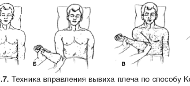 Закрытый чрезмыщелковый перелом плечевой кости