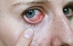 Болит уголок глаза: внешний, при моргании, у переносицы