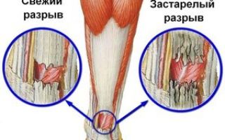 Разрыв связок коленного сустава: сколько времени заживает, как долго