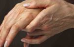 Немеет правая рука от локтя: до пальцев, причины, лечение