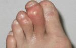Болит подушечка большого пальца на ноге: опухла, при нажатии