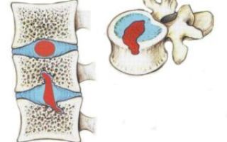 Грыжа грудного отдела позвоночника: симптомы и лечение, шморля