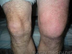 Травма колена, растяжение связок: лечение, что делать