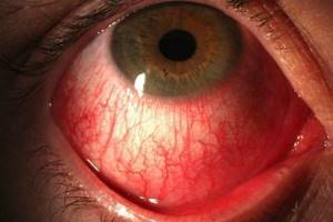 Красные глаза и болят: причины, покраснел один, что делать