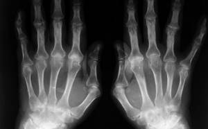 Болит сустав указательного пальца правой руки: боль, артрит