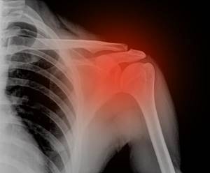 Упражнения после перелома плечевой кости: реабилитация, лечебная гимнастика