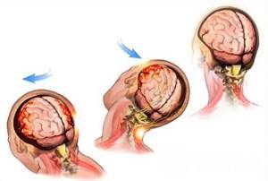 Гематома головного мозга: субдуральная, эпидуральная, симптомы