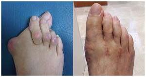 Болит шишка на ноге у большого пальца: что делать, чем лечить
