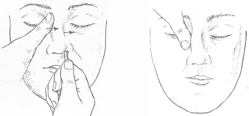 Перелом носа: степень тяжести вреда здоровью, открытый, закрытый