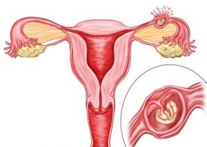 Болят яичники: причины, почему, у женщин, при беременности