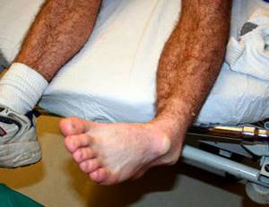 Вывих ноги в районе щиколотки: лечение в домашних условиях
