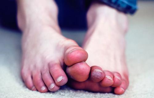 Немеют пальцы на ногах: причина, почему, с каким заболеванием связано