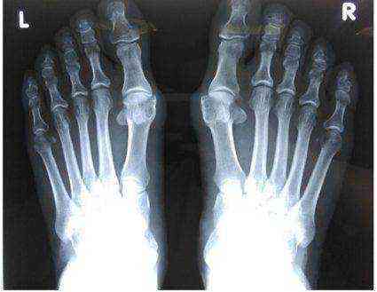 Болит второй палец на ноге: как избавиться от боли, у основания