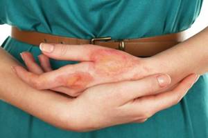 Химический ожог кожи: лечение в домашних условиях, первая помощь