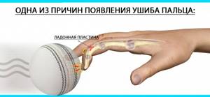 Ушиб пальца на руке: симптомы, признаки, как отличить