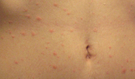 Водянистые пузырьки на коже: скопление, лечение