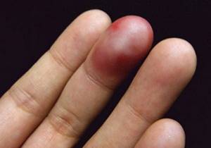 Как лечить ушиб пальца на руке: чем лечить, лечение