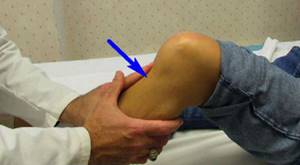 Повреждение связок коленного сустава: сроки восстановления