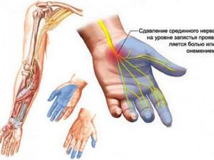 Немеют пальцы правой руки: причина и что делать, лечение