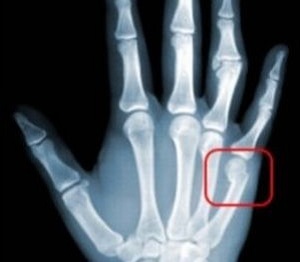 Перелом мизинца на руке: сколько заживает, сколько носить гипс