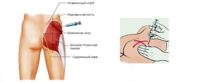 Как делать уколы внутримышечно: самому себе, в руку