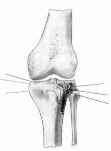 Импрессионный перелом мыщелка бедренной кости: латерального
