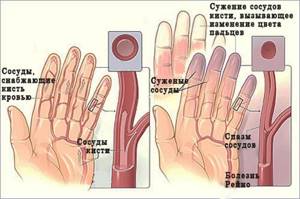 Немеет средний палец на правой руке: причины, лечение