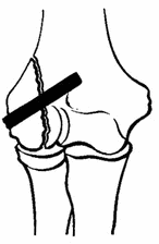 Перелом мыщелка плечевой кости: медиального, закрытый