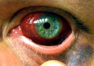 Травма глаза: лечение, в домашних условиях, капли, первая помощь