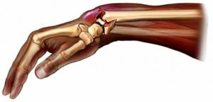 Лечебная гимнастика при переломе лучевой кости руки: упражнения