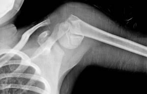 Перелом хирургической шейки плечевой кости: закрытый