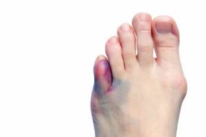 Перелом мизинца на ноге: симптомы, как определить
