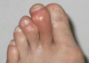 Болит подушечка большого пальца на ноге: опухла, при нажатии