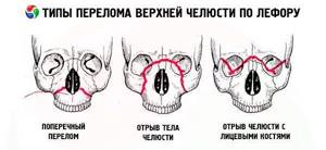 Перелом верхней челюсти: классификация, лечение, виды
