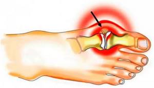 Болит сустав большого пальца на ноге: как лечить, лечение