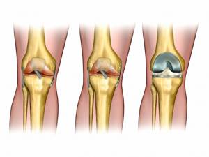 Эндопротезирование коленного сустава: реабилитация после операции