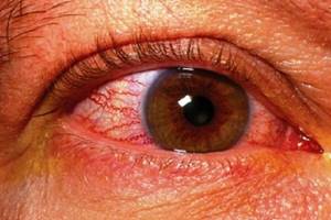 Разрыв сетчатки глаза: серьезно ли это, причины, лечение