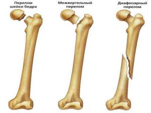 Закрытый перелом правой бедренной кости: со смещением, помощь