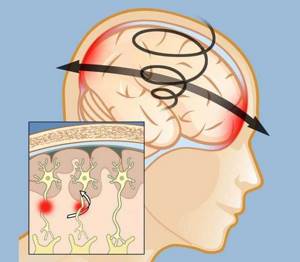 Сотрясение головного мозга: симптомы и лечение, первая помощь