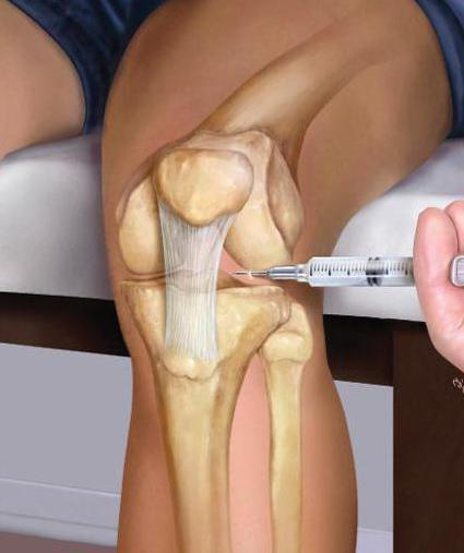 Уколы в коленный сустав при артрозе: препараты, гиалуроновая кислота