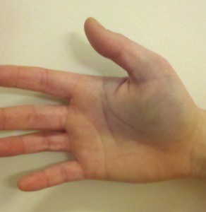 Перелом мизинца на руке: сколько заживает, сколько носить гипс