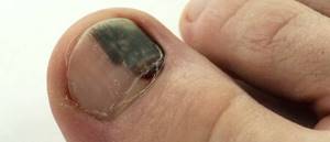 Синяк под ногтем большого пальца ноги: как лечить, избавиться
