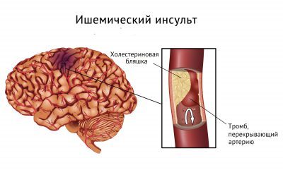 Болит левая часть головы: головная боль, слева, почему, причины