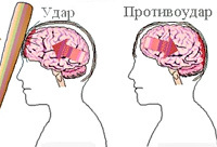 Ушиб головного мозга: симптомы и лечение, последствия